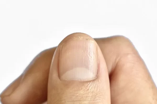 What causes wavy nails? Along with precise methods of prevention and treatment